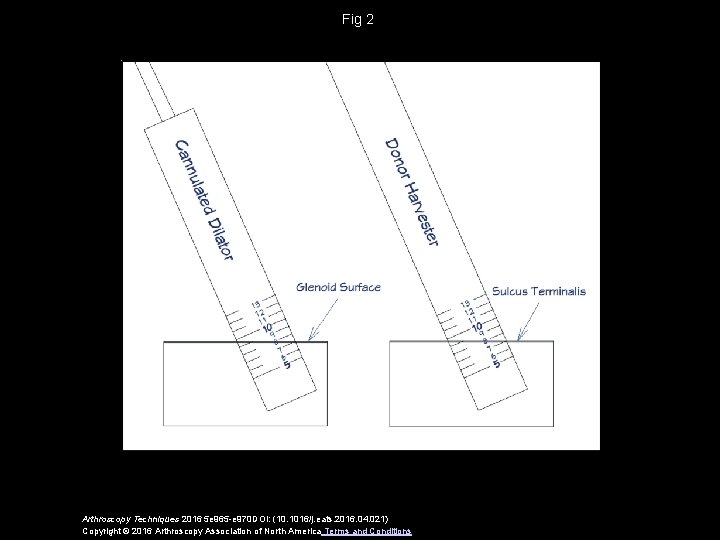 Fig 2 Arthroscopy Techniques 2016 5 e 965 -e 970 DOI: (10. 1016/j. eats.