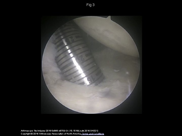 Fig 3 Arthroscopy Techniques 2016 5 e 965 -e 970 DOI: (10. 1016/j. eats.