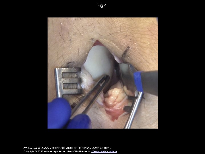 Fig 4 Arthroscopy Techniques 2016 5 e 965 -e 970 DOI: (10. 1016/j. eats.