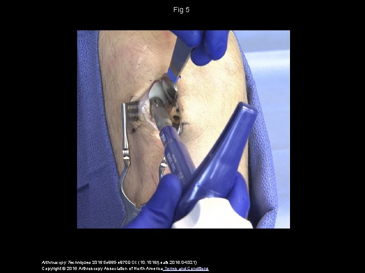 Fig 5 Arthroscopy Techniques 2016 5 e 965 -e 970 DOI: (10. 1016/j. eats.