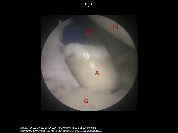 Fig 6 Arthroscopy Techniques 2016 5 e 965 -e 970 DOI: (10. 1016/j. eats.