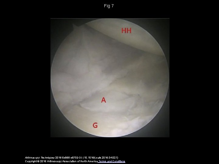 Fig 7 Arthroscopy Techniques 2016 5 e 965 -e 970 DOI: (10. 1016/j. eats.