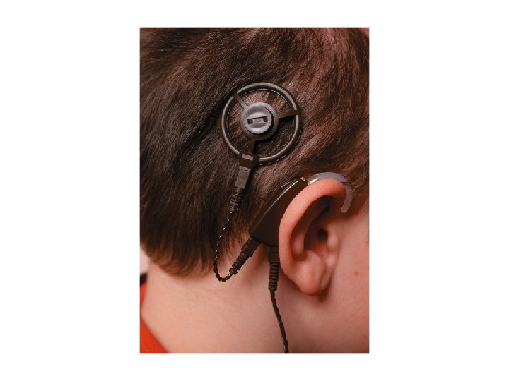 Cochlear implant Cochlear implant