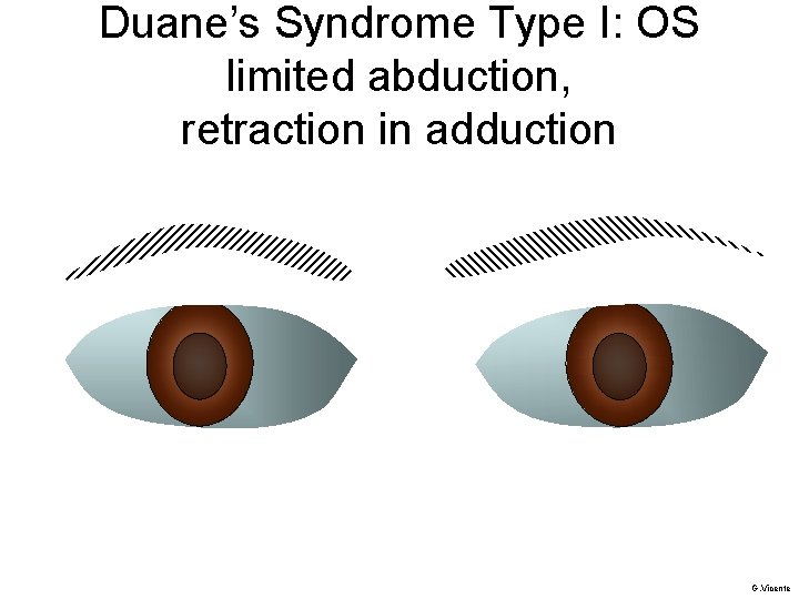 Duane’s Syndrome Type I: OS limited abduction, retraction in adduction G. Vicente 