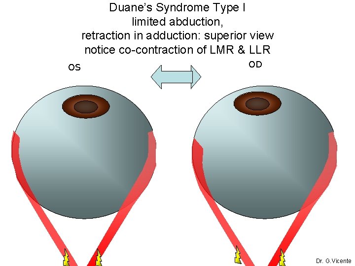 Duane’s Syndrome Type I limited abduction, retraction in adduction: superior view notice co-contraction of