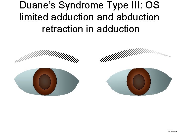 Duane’s Syndrome Type III: OS limited adduction and abduction retraction in adduction G. Vicente