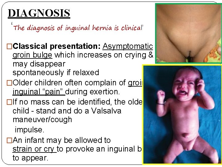 DIAGNOSIS ‘The diagnosis of inguinal hernia is clinical’ �Classical presentation: Asymptomatic groin bulge which