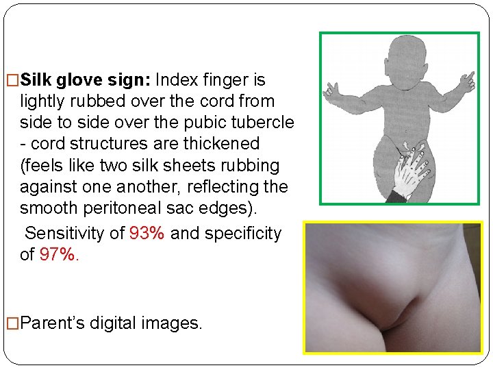 �Silk glove sign: Index finger is lightly rubbed over the cord from side to