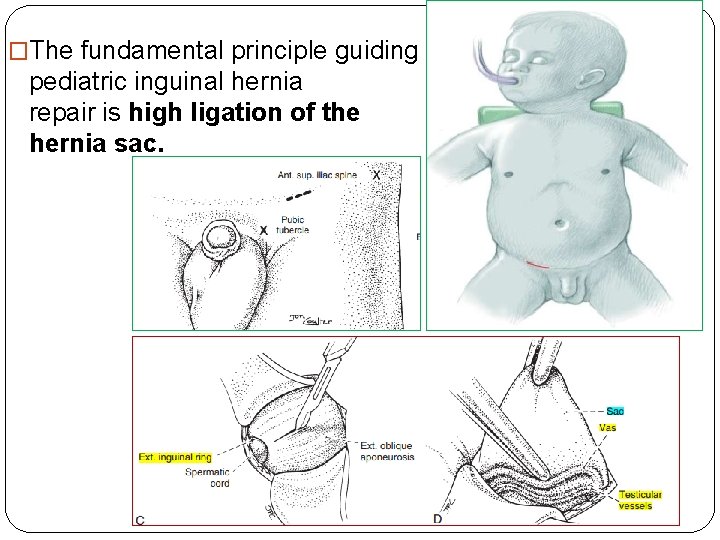 �The fundamental principle guiding pediatric inguinal hernia repair is high ligation of the hernia