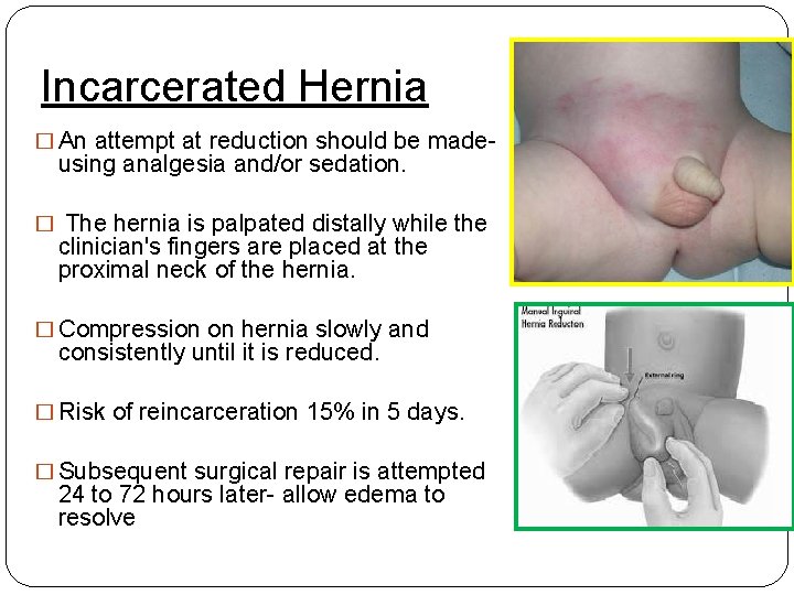 Incarcerated Hernia � An attempt at reduction should be made- using analgesia and/or sedation.