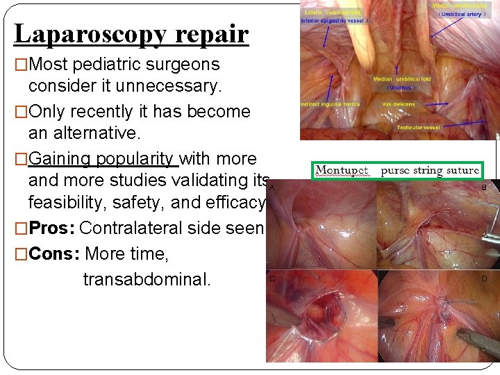 Laparoscopy repair �Most pediatric surgeons consider it unnecessary. �Only recently it has become an