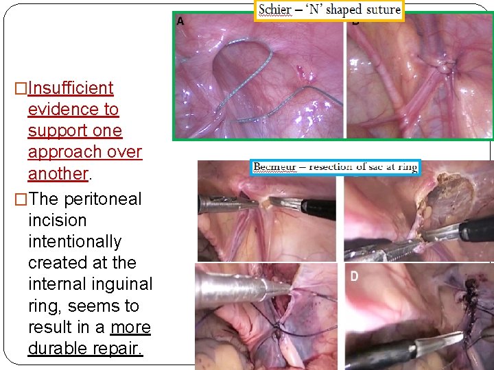 �Insufficient evidence to support one approach over another. �The peritoneal incision intentionally created at