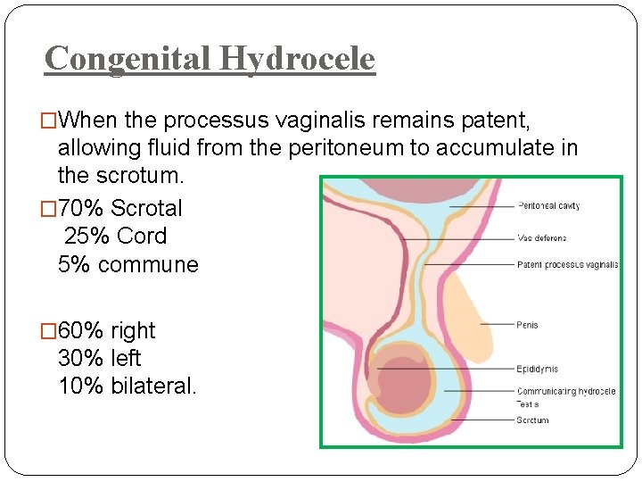 Congenital Hydrocele �When the processus vaginalis remains patent, allowing fluid from the peritoneum to