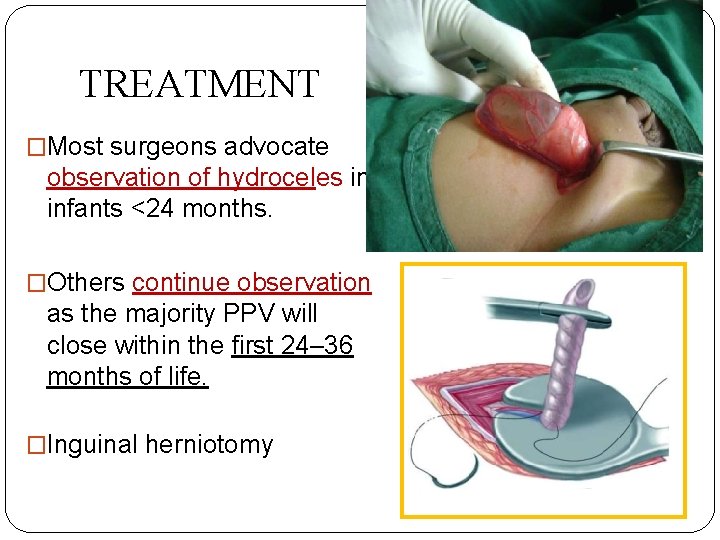 TREATMENT �Most surgeons advocate observation of hydroceles in infants <24 months. �Others continue observation