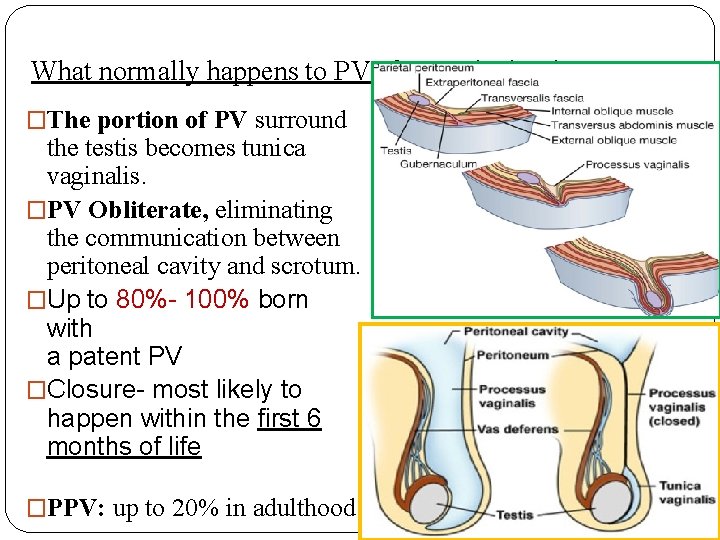 What normally happens to PV after testicular descent? �The portion of PV surround the