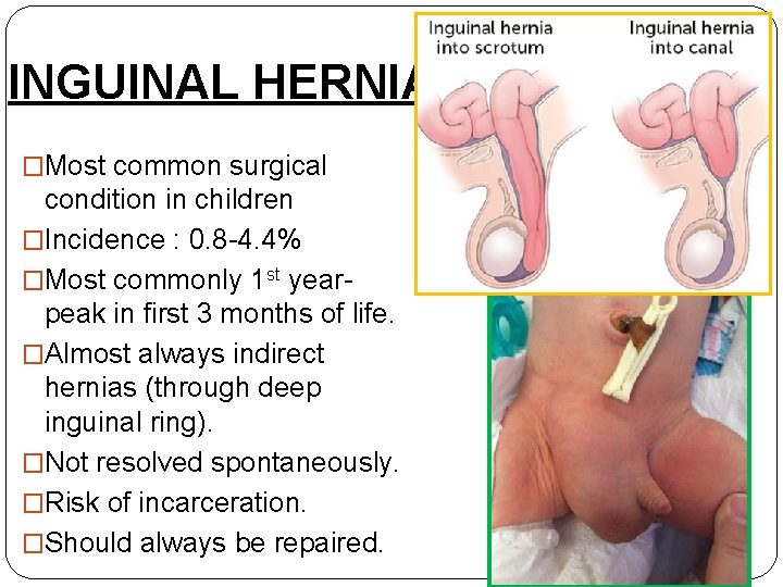 INGUINAL HERNIA �Most common surgical condition in children �Incidence : 0. 8 -4. 4%