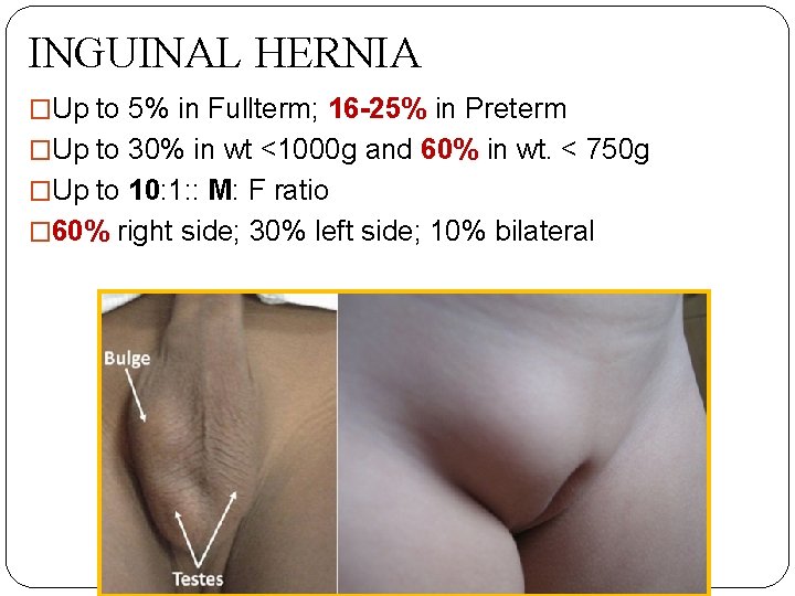INGUINAL HERNIA �Up to 5% in Fullterm; 16 -25% in Preterm �Up to 30%