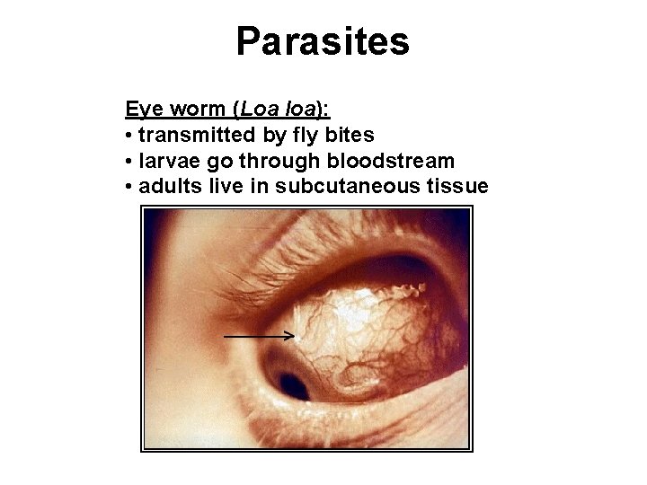 Parasites Eye worm (Loa loa): • transmitted by fly bites • larvae go through