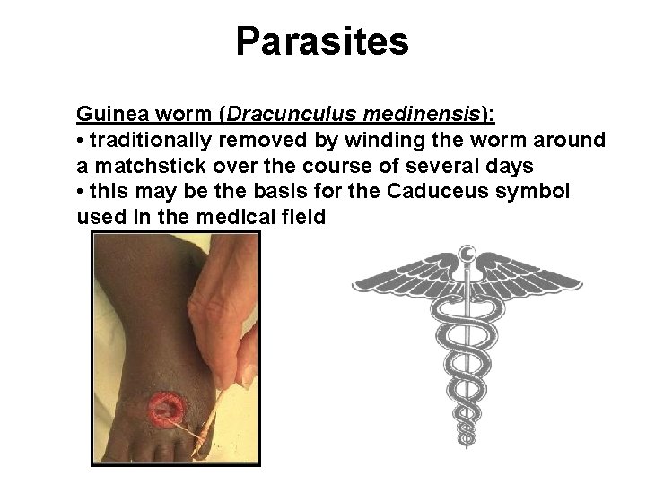 Parasites Guinea worm (Dracunculus medinensis): • traditionally removed by winding the worm around a