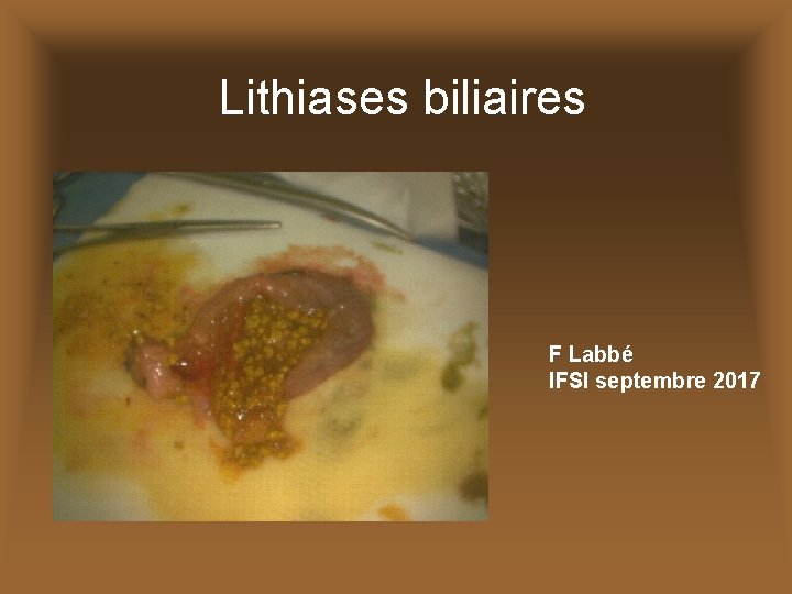 Lithiases biliaires F Labbé IFSI septembre 2017 