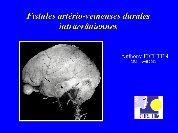 Fistules artério-veineuses durales intracrâniennes Anthony FICHTEN DES – Avril 2003 