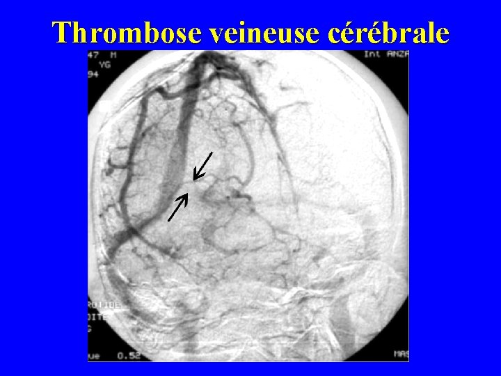 Thrombose veineuse cérébrale 