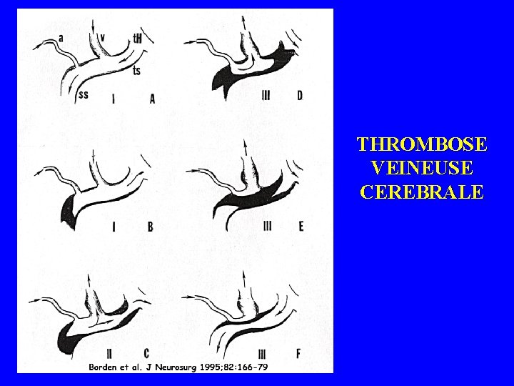 THROMBOSE VEINEUSE CEREBRALE 