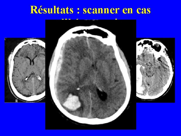 Résultats : scanner en cas d’hémorragie 