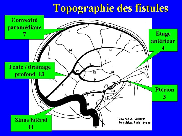 Topographie des fistules Convexité paramédiane 7 Étage antérieur 4 Tente / drainage profond 13