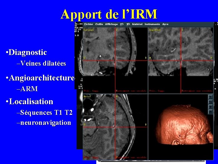 Apport de l’IRM • Diagnostic –Veines dilatées • Angioarchitecture –ARM • Localisation –Séquences T