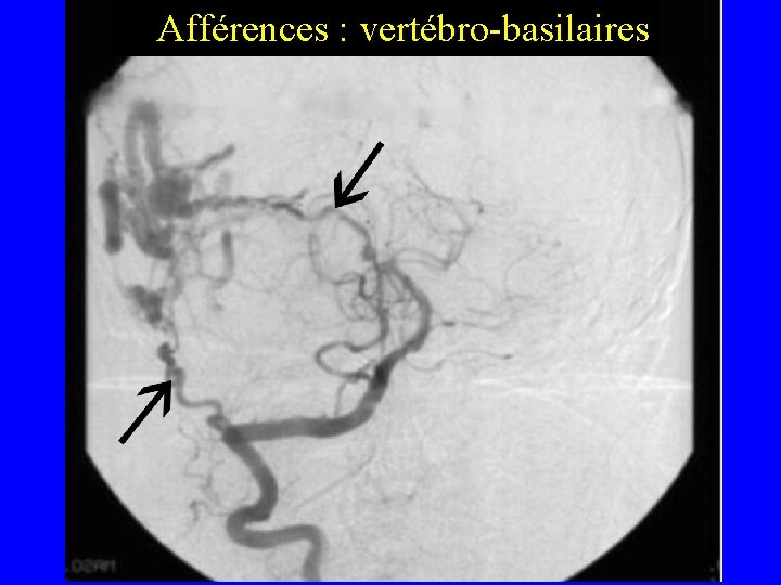  Afférences : vertébro-basilaires 