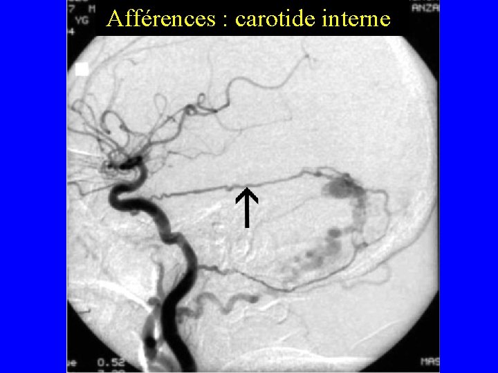 Afférences : carotide interne Afférences : carotide interne
