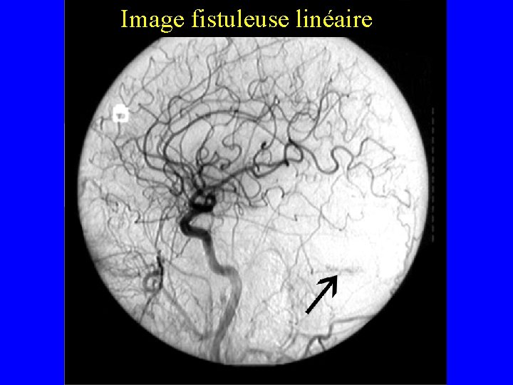 Image fistuleuse linéaire 