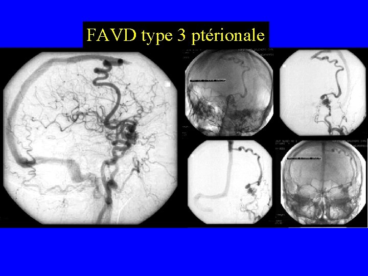 FAVD type 3 ptérionale 