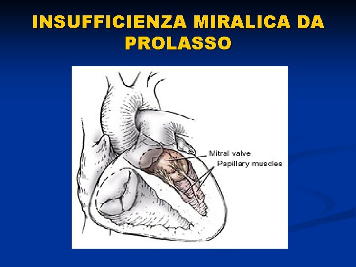 INSUFFICIENZA MIRALICA DA PROLASSO 
