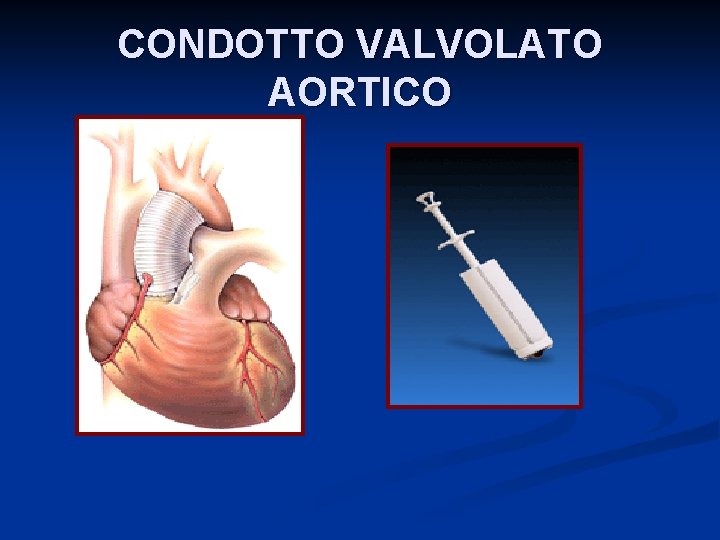 CONDOTTO VALVOLATO AORTICO 