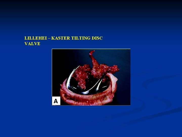 LILLEHEI – KASTER TILTING DISC VALVE 