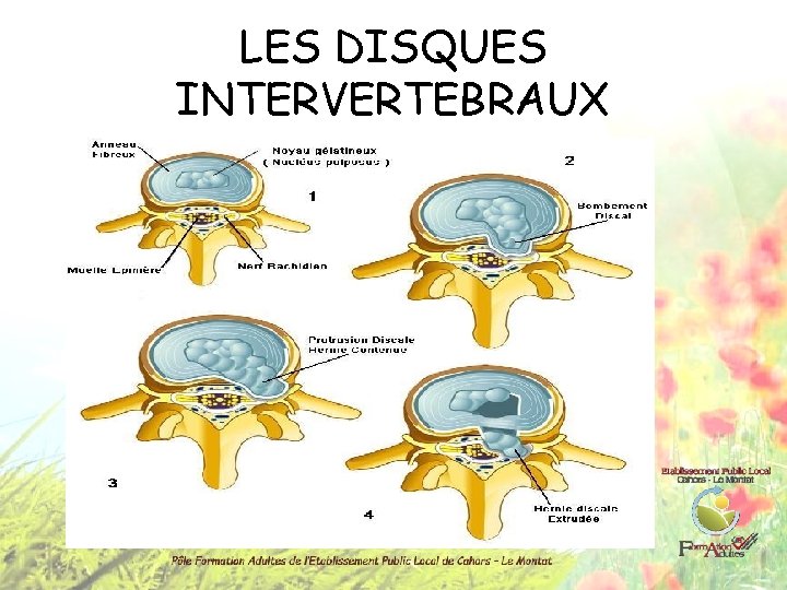 LES DISQUES INTERVERTEBRAUX 