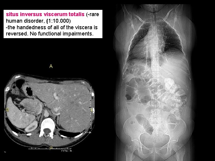 situs inversus viscerum totalis (-rare human disorder, (1: 10. 000) -the handedness of all