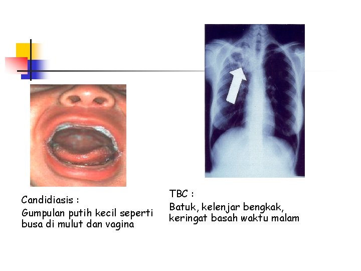 Candidiasis : Gumpulan putih kecil seperti busa di mulut dan vagina TBC : Batuk,