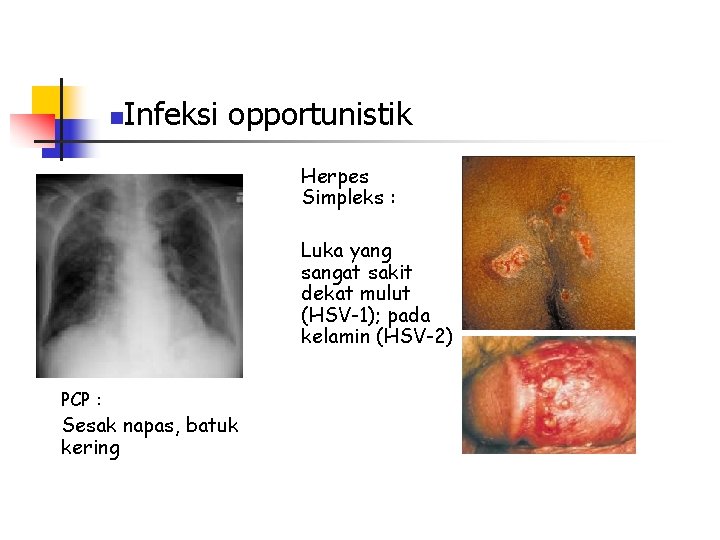 n Infeksi opportunistik Herpes Simpleks : Luka yang sangat sakit dekat mulut (HSV-1); pada