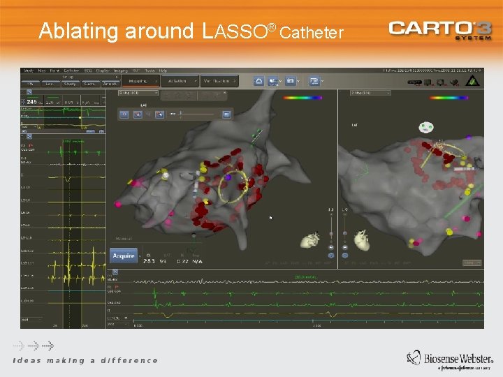 Ablating around LASSO® Catheter 