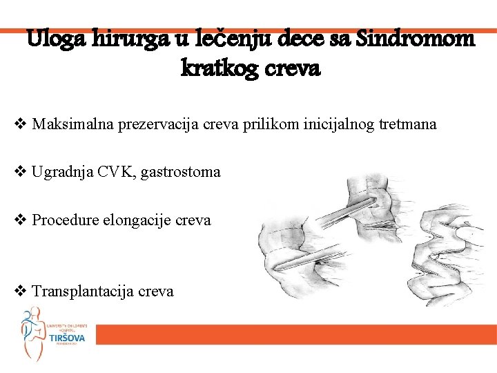 Uloga hirurga u lečenju dece sa Sindromom kratkog creva v Maksimalna prezervacija creva prilikom