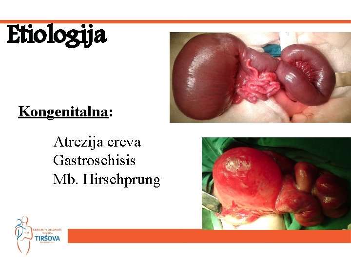 Etiologija Kongenitalna: Atrezija creva Gastroschisis Mb. Hirschprung 