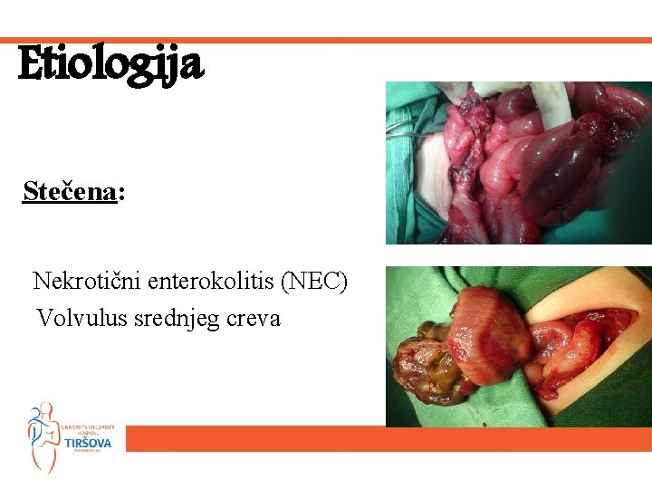 Etiologija Stečena: Nekrotični enterokolitis (NEC) Volvulus srednjeg creva 