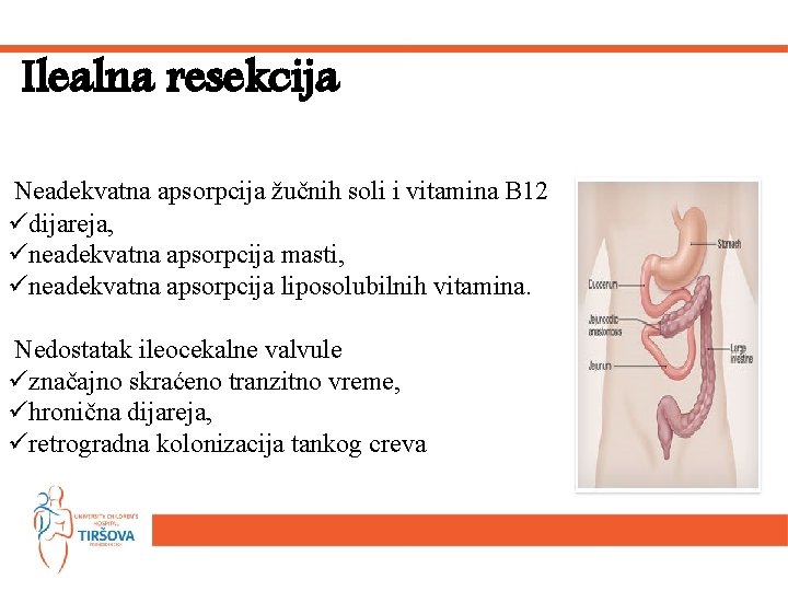 Ilealna resekcija Neadekvatna apsorpcija žučnih soli i vitamina B 12 üdijareja, üneadekvatna apsorpcija masti,