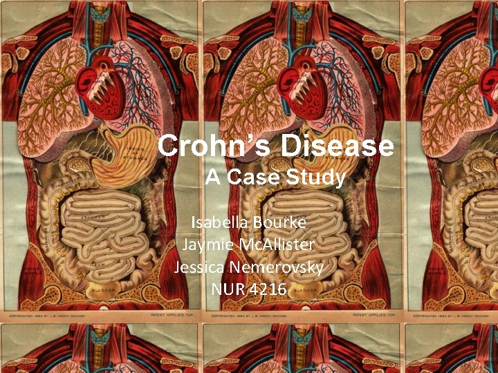 Crohn’s Disease A Case Study Isabella Bourke Jaymie Mc. Allister Jessica Nemerovsky NUR 4216