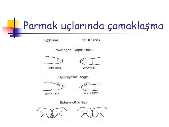 Parmak uçlarında çomaklaşma 