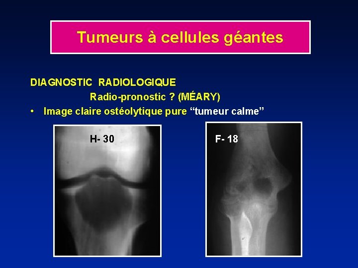 Tumeurs à cellules géantes DIAGNOSTIC RADIOLOGIQUE Radio-pronostic ? (MÉARY) • Image claire ostéolytique pure