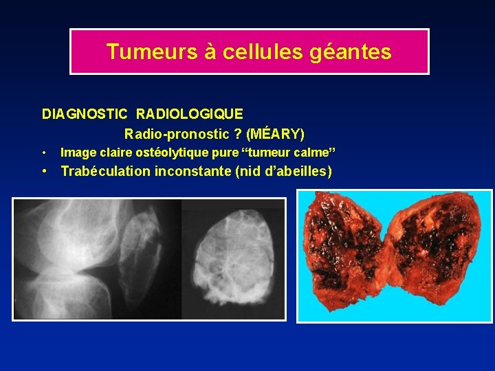 Tumeurs à cellules géantes DIAGNOSTIC RADIOLOGIQUE Radio-pronostic ? (MÉARY) • Image claire ostéolytique pure